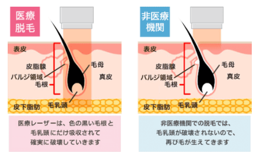 脱毛